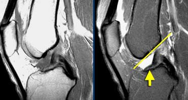 Torn ACL. ACL fibers are too flat (yellow arrow) compared to intercondylar roof (Blumensaat's line).