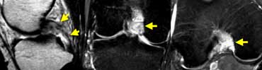 Acute PCL-tear: In the coronal and axial plane most of the fibers are gone so it's a high grade tear.