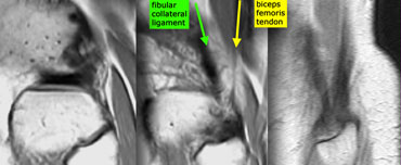 Posterolateral corner anatomy from medial to lateral on sagittal images. Fibular collateral ligament (green) and Biceps femoris tendon (yellow) form a letter V and insert as conjoined tendon on fibular head.