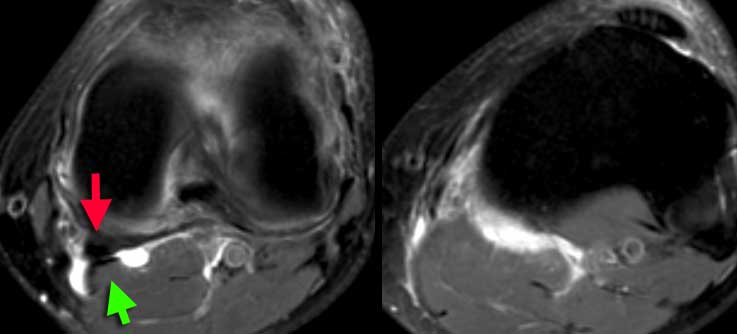 LEFT: popliteal cyst originating between semimembranosus tendon (red arrow) and gastrocnemius muscle and tendon (green arrow).RIGHT: ruptured popliteal cyst with fluid tracking down the muscles.