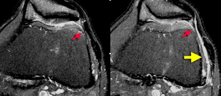 Iliotibial Band Friction syndrome : Fluid within a bursa is seen between the iliotibial tract and the femur (yellow arrows). Joint fluid stops at the red arrows.