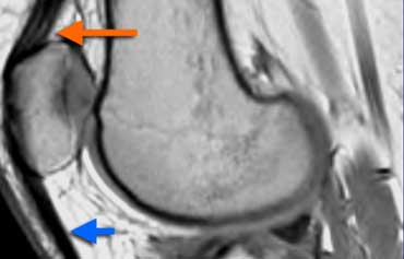 Normal Extensor mechanism: The quadriceps tendon comes in three layers (orange arrow). Patellar tendon (blue arrow) and quadriceps tendon have a sharp posterior demarcation.