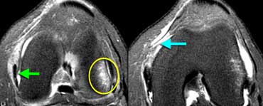 LEFT: Bone bruise lateral condyle (yellow circle). Normal MCL (green arrow) but missing patellar femoral ligament anterior to it.RIGHT: Medial patellar femoral ligament thorn from femoral attachment.