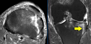 Tibiaplateau fracture. This also is a osteochondral fracture as the fracture line extends all the way through the cartilage to the joint surface.