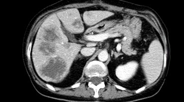 Hypovascular metastases seen as hypodense lesions in the late portal venous phase. Notice some rim enhancement of the more viable peripheral areas of the metastases.