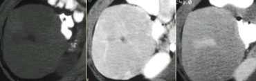 FNH with central scar seen in NECT, portal venous phase and equilibrium phase.
