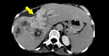 Delayed phase image of a cholangiocarcinoma with relative dense fibrous stroma with retraction of liver capsule