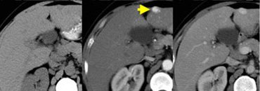 Flash filling hemangioma in unenhanced, arterial and portal venous phase. Notice it matches the bloodpool.