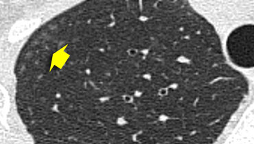 Ill defined centrilobular nodules of ground glass density in a patient with hypersensitivity pneumonitis