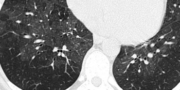 Mosaic pattern in a patient with hypersensitivity pneumonitis