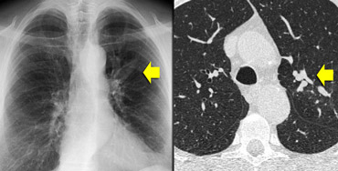 ABPA: glove-finger shadow due to mucoid impaction in central bronchiectasis in a patient with asthma.