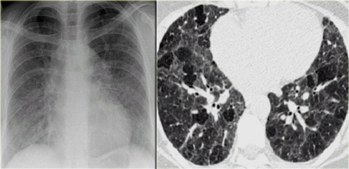 Chronic hypersensitivity pneumonitis: Nonspecific chest film, typical HRCT-findings.