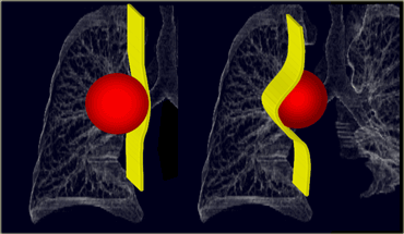 LEFT: A lung mass abutts the mediastinal surface and creates acute angles with the lung.RIGHT: A mediastinal mass will sit under the surface of the mediastinum, creating obtuse angles with the lung.