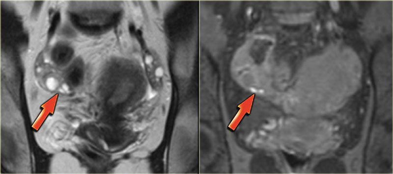 Coronal T2 and T1-Fatsat images: superficial serosal implants of endometriosis