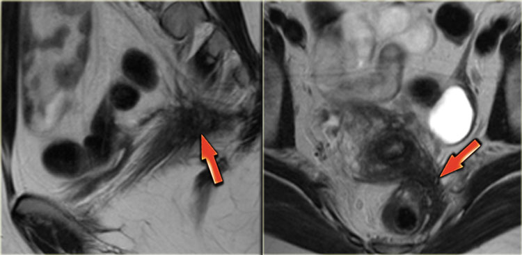 Endometriosis with involvement of the left sacrouterine ligament