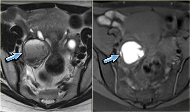 T2- and fatsat T1-images of an endometrioma with hypointensity on T2 (shading), fluid-fluid levels on T2 (left) and hyperintense blood on T1WI with fatsat (right).. 