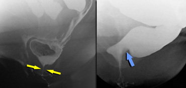 LEFT: Hypertonic sphincter (during defecation).RIGHT: Impression of hypertonic puborectal muscle (non-relaxing during defecation).