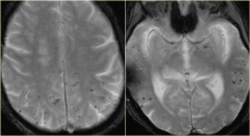 CAA - Multifocal subcortical black dots in a older patient.