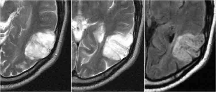 DNET: T2WI and FLAIR show characteristic bubbly appearance and swelling of affected gyri. Notice scalopping of the skull due to slow growth of the lesion.