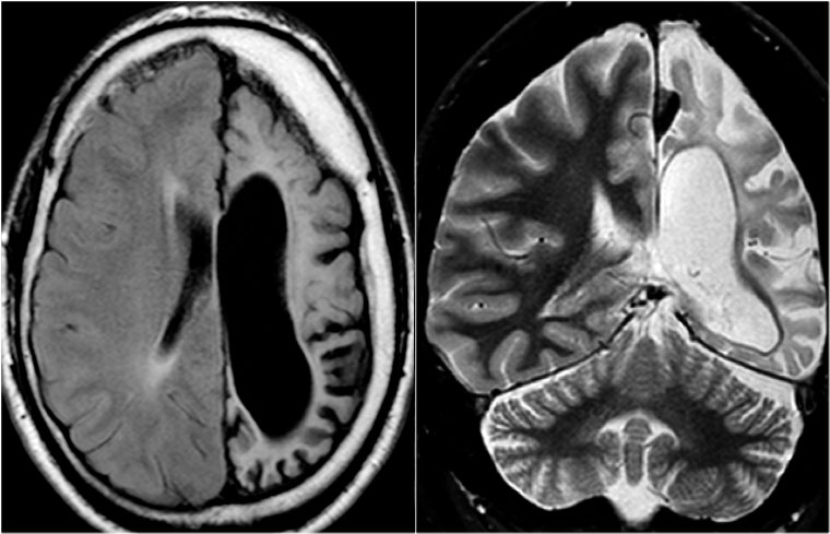 Rasmussen's encephalitis. Axial FLAIR and coronal T2WI show atrophy of the left cerebral hemisphere with enlargement of the lateral ventricle.