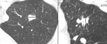 Transverse image (left) and coronal reconstruction (right)Three-dimensional ratio = transverse dimension : vertical dimension