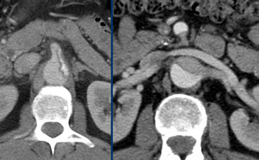 Left: Continued dissection into the celic trunk showing bigger false lumen, significantly contributing to organ perfusion.Right: : SMA and renal artery involvement, illustrating possible cause of organ malperfusion