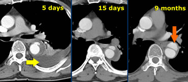 Type B aortic dissection in a non-operable patient. At 5 days flow reappeared in false lumen. Finally at 9 months a saccular aneurysm has formed.