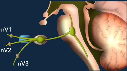 Trigeminal neuralgia