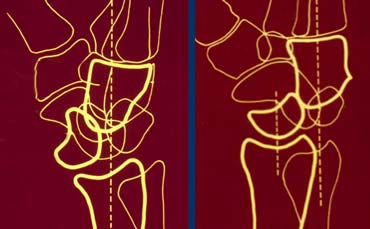 LEFT: Lunate dislocation: capitate is centered over the radius and lunate is tilted out.RIGHT: Perilunate dislocation: lunate is centered over the radius and capitate is tilted out dorsally.