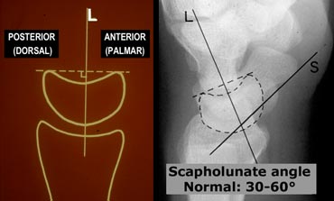 LEFT: Lunate axis drawn perpendicular to a line joining the distal palmar and dorsal bordersRIGHT: Radiograph with lunate and scaphoid axis drawn.