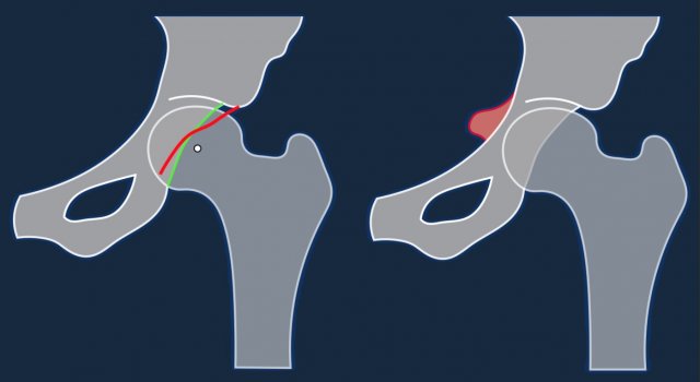 Femoroacetabular impingement syndrome