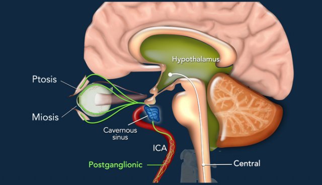 Horner syndrome.