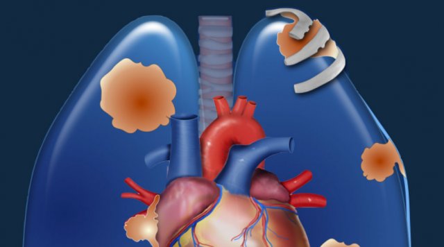 TNM classification 9ᵗʰ edition
