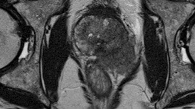 Prostate Cancer - PI-RADS v2.1