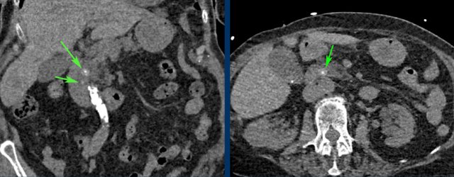 CT for suspected aortic dissection. The only relevant finding were two CBD stones best visible on the non-contrast series (arrows).