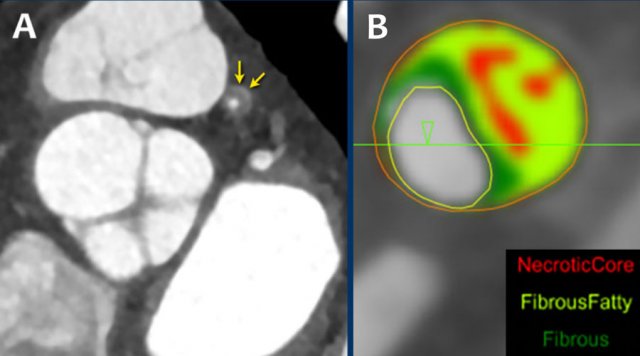 A: On the coronal image the so-called napkin-ring sign (dark area adjacent to the lumen, surrounded by a higher “ring-like” attenuation (white arrows). B: Tissue characterization on CT by HU number