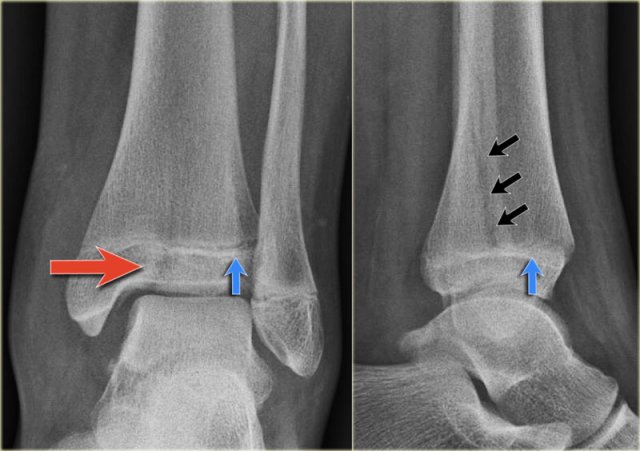 Triplane fracture