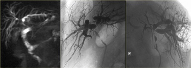 Hiar Cholagiocarcinoma. Notice the superiority of ERCP to MRCP. The image on the right nicely demonstrates the shouldering at the hilum and the multiple strictures.