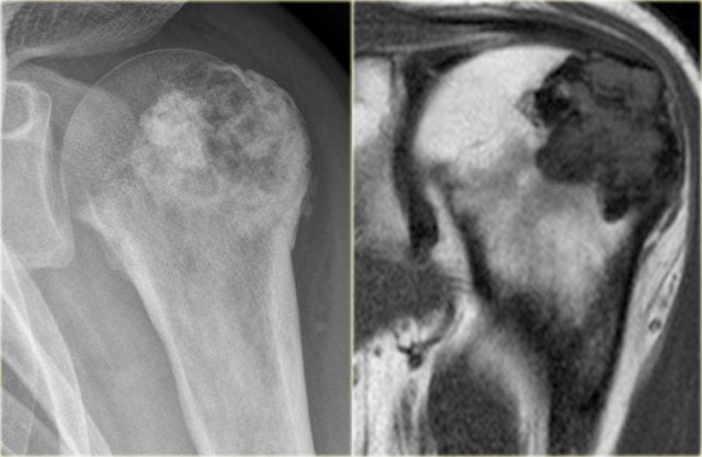 Chondroblastoma in proximal humerus