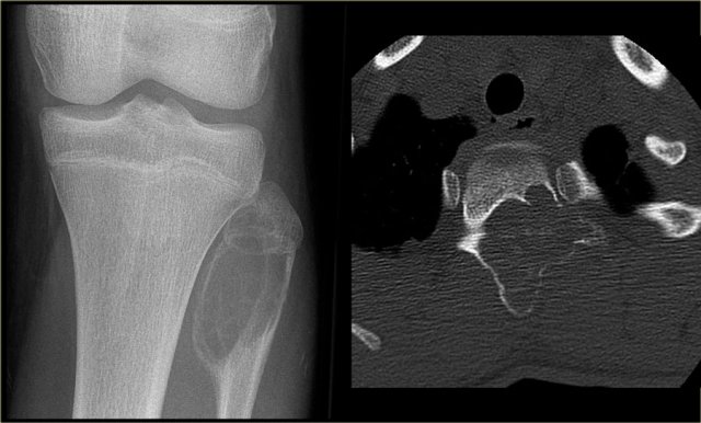ABC of the proximal fibula: well-defined, expansile osteolytic lesion with thin peripheral bone shell