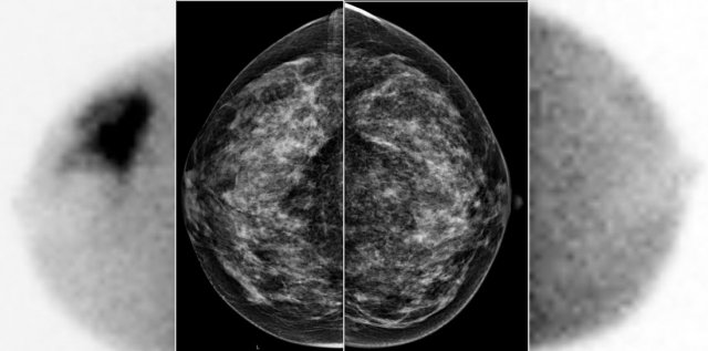 A large tumor in the right breast is easily detected with BSGI, while hardly visible on the mammogram.