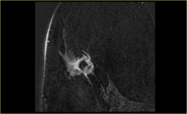 Invasive ductal carcinoma with rim enhancement