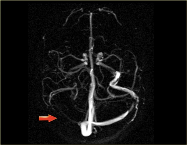 Transverse MIP image of a Phase-Contrast angiography.The right transverse sinus and jugular vein have no signal due to thrombosis.