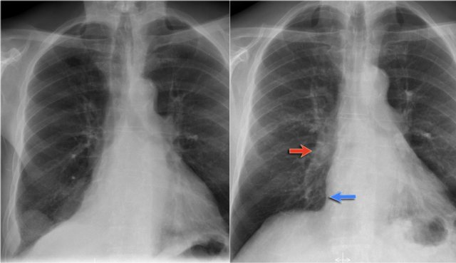 LEFT: Lower lobe atelectasis. RIGHT: Follow up.