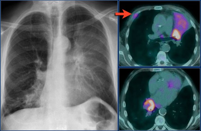 Lungcarcinoma on the left obstructing the upper lobe bronchus and also a lung carcinoma on the right obstructing the right lower lobe.