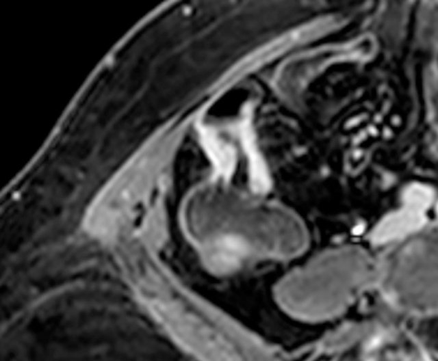 Thickened terminal ileum segment with marked enhancement on axial post-contrast T1W image with fatsat.