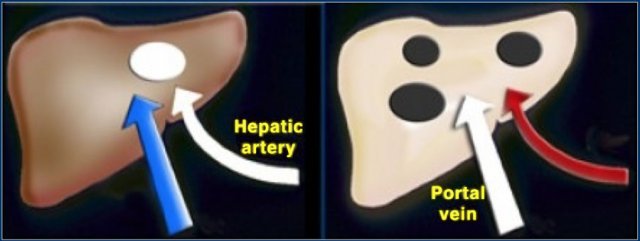 Hypervascular tumor (left) enhances in late arterial phase. Hypovascular tumor (right) enhances poorly and is best seen in the hepatic phase