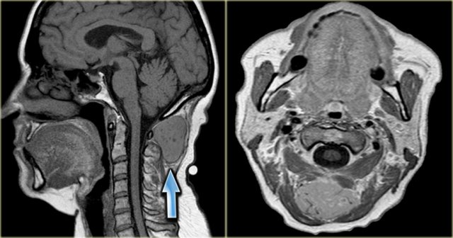 Sagittal T1-weighted image and axial image post-Gadolinium