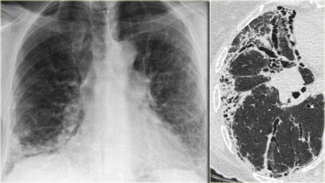 Chest film in a patient with UIP demonstrating the reticular pattern in basal and subpleural distribution due to honeycombing.