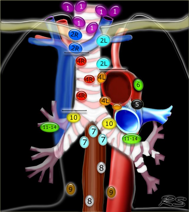 Regional lymph node classification for lung cancer staging  adapted from the American Thoracic Society mapping scheme